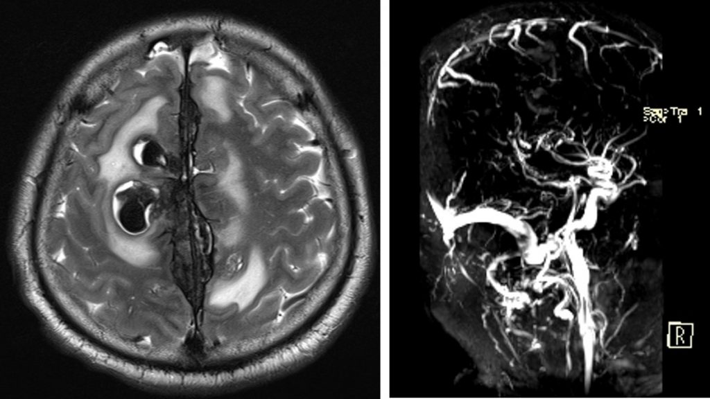 Superior Sagittal Sinus Thrombosis With Intraparenchymal Haemorrhages Radiology Cases 4102