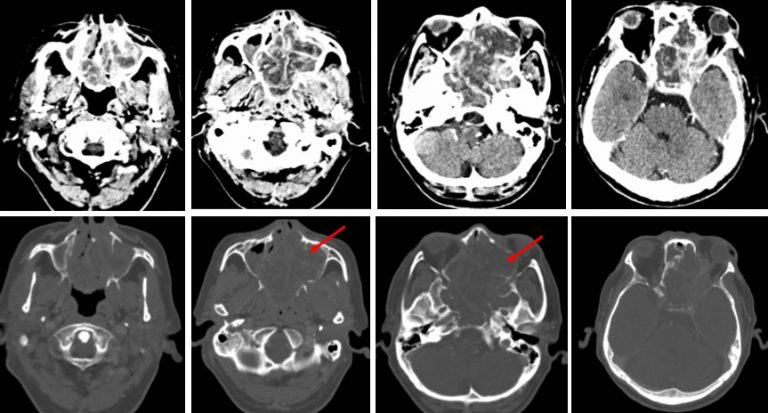 Adenoid cystic carcinoma of ethmoidal sinus – Radiology Cases