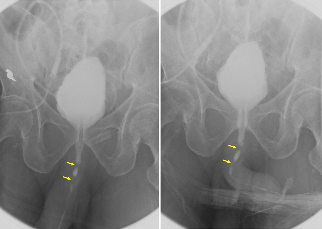 Anterior Urethral Strictures Radiology Cases 6684