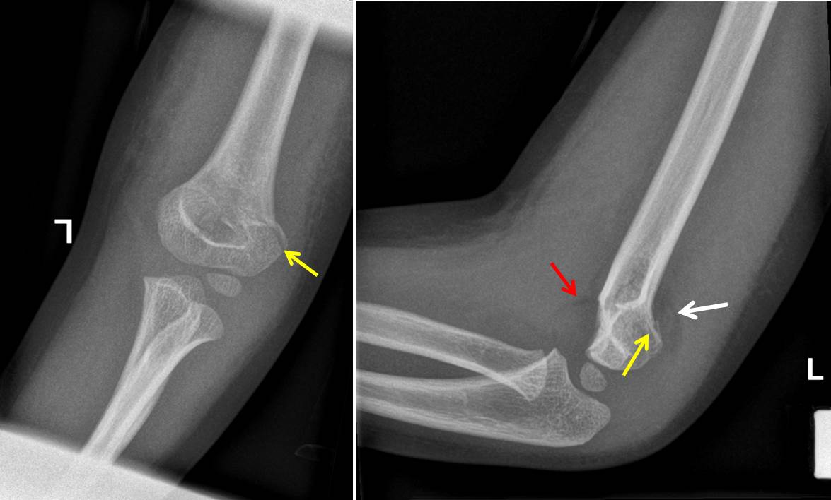 Supracondylar Fracture Radiology Cases 2313