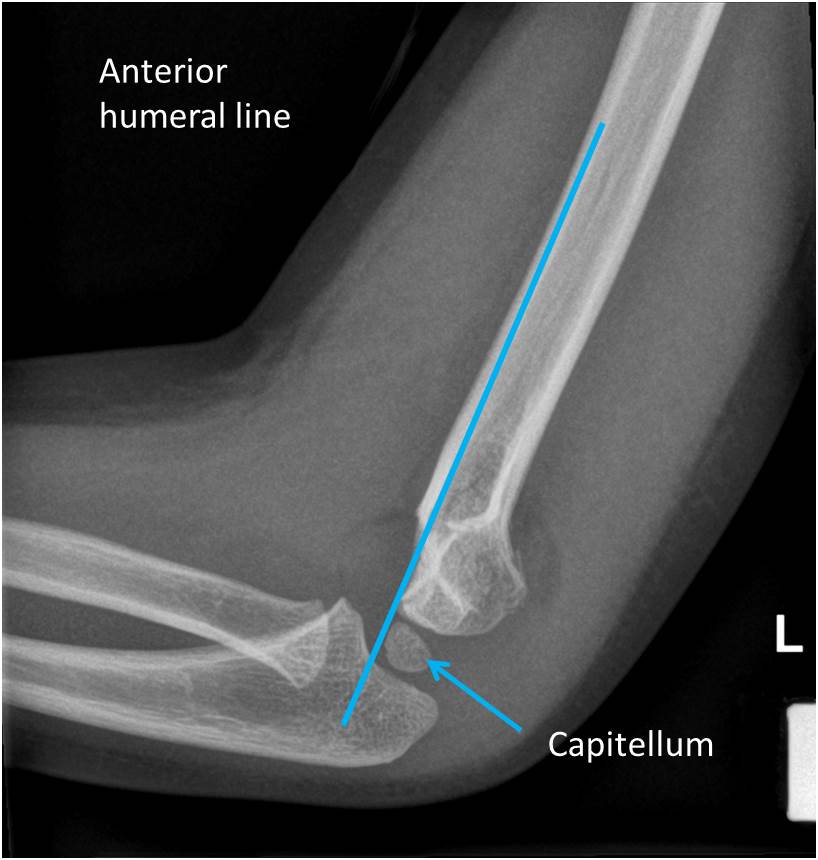 Supracondylar fracture – Radiology Cases