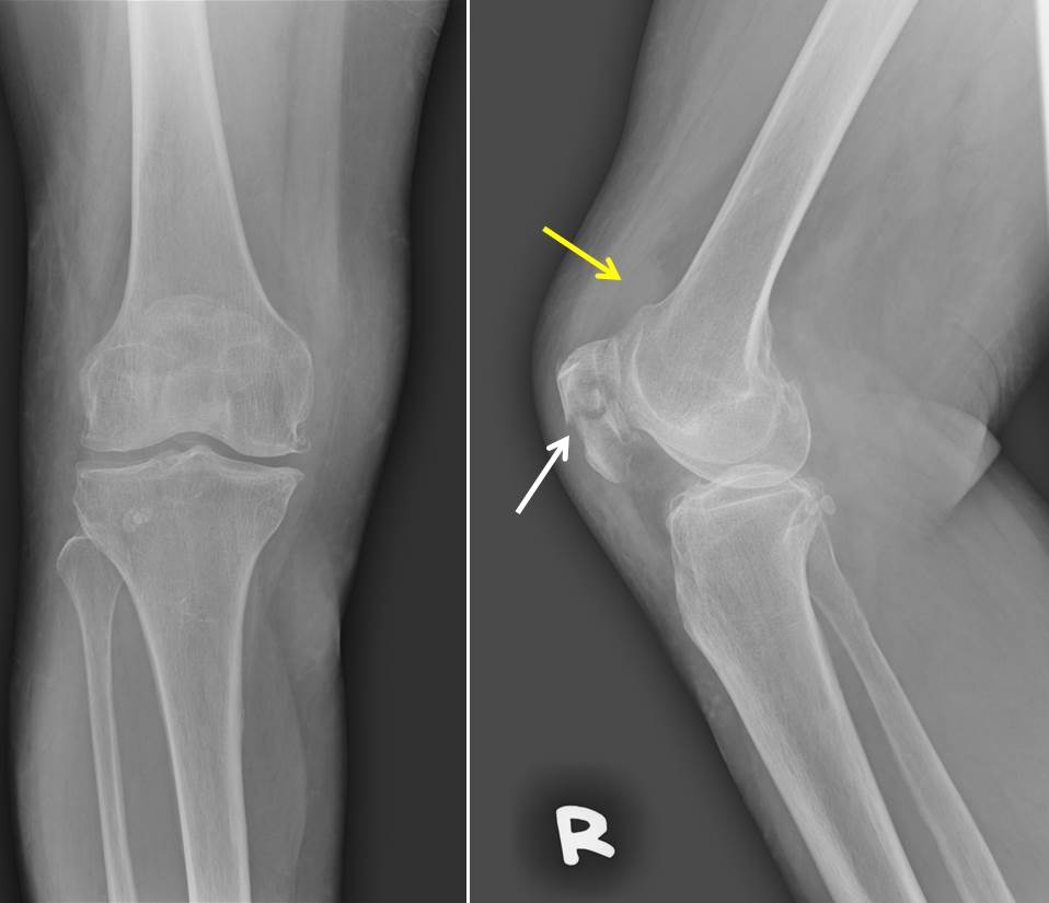 Patella fracture – Radiology Cases