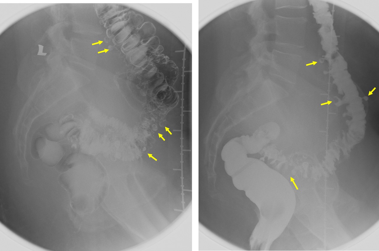 Colonic Diverticulosis Radiology Cases   Picture6 3 