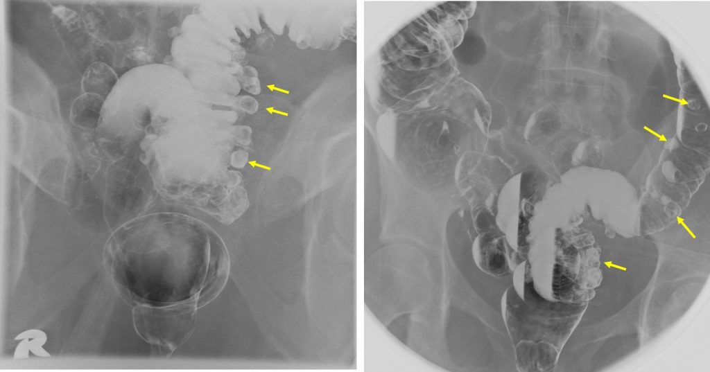 Colonic Diverticulosis Radiology Cases   Picture7 1 1024x537 