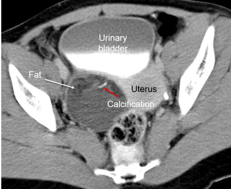 Ovarian Cyst CT Scan