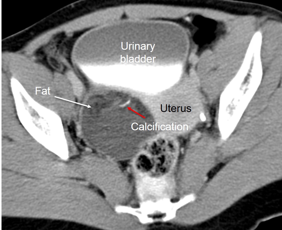 Ovarian Cyst On Ct Scan