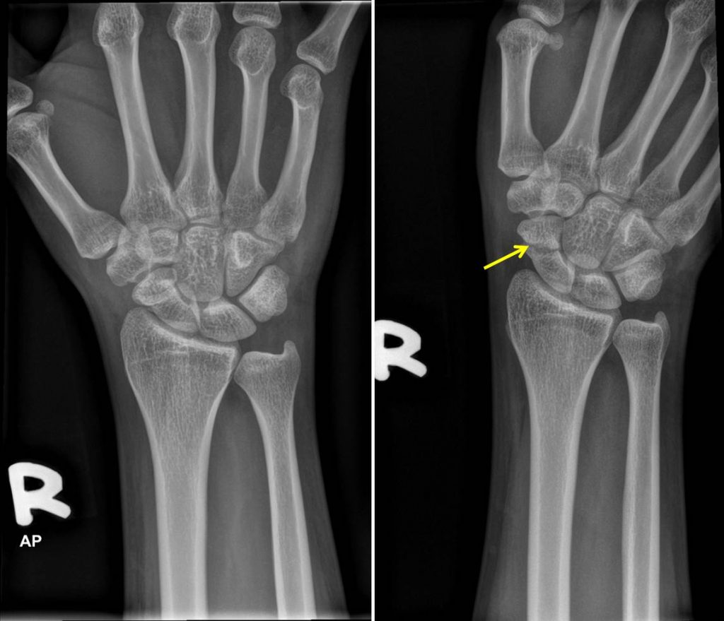 Scaphoid fracture – Radiology Cases