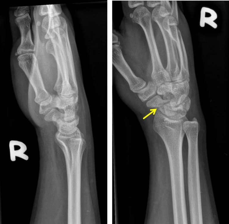 Scaphoid Fracture Radiology Cases