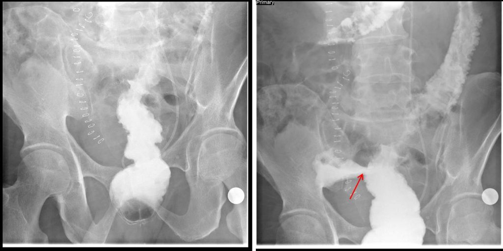 Pneumoperitoneum: Rigler sign – Radiology Cases