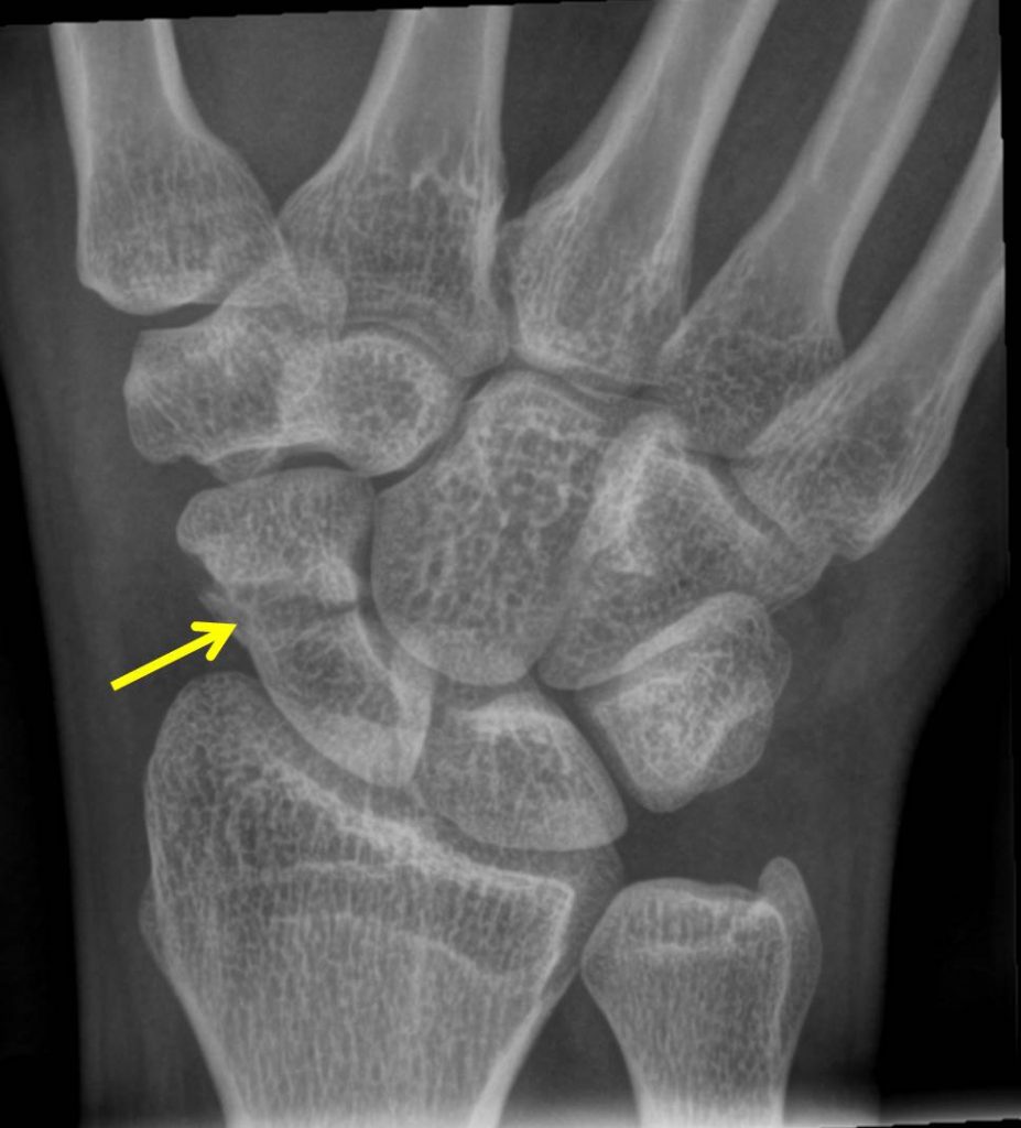 Scaphoid Fracture Causes Symptoms And Treatment - vrogue.co