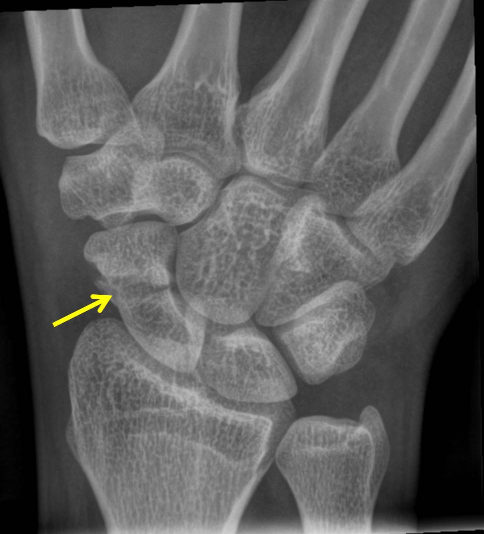 Scaphoid fracture – Radiology Cases
