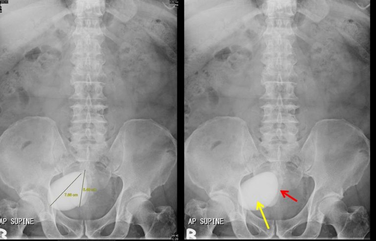 Urinary Bladder Calculi – Radiology Cases