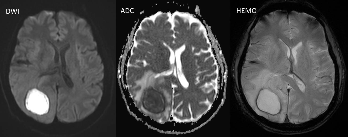 Cerebral abscess – Radiology Cases