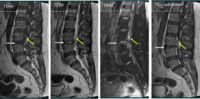 Sequestrated disc – Radiology Cases