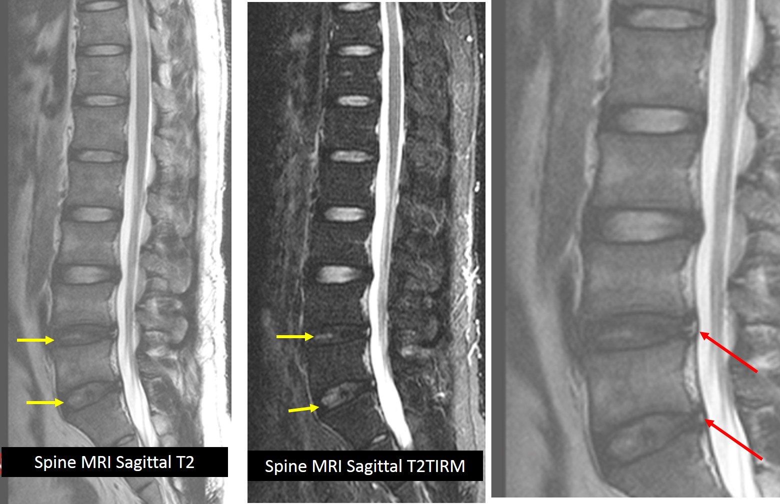 Posterior annular tear with facet joint injection – Radiology Cases