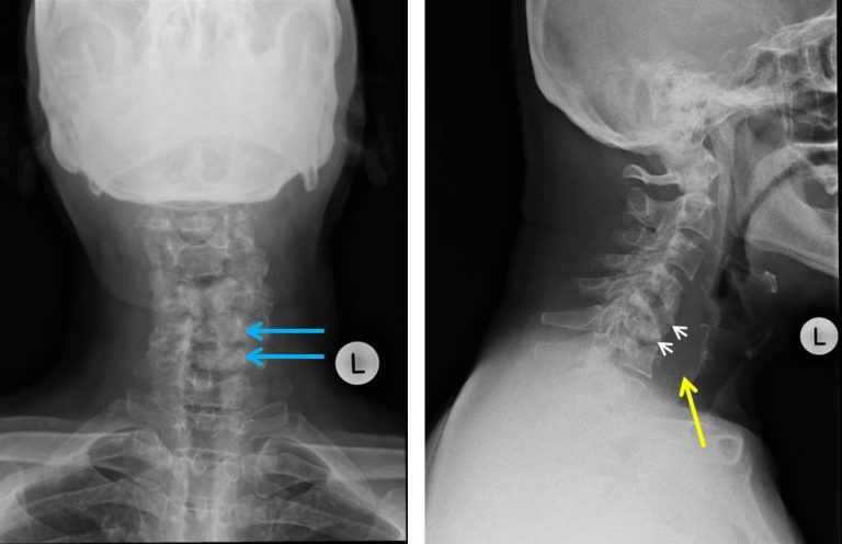 Tuberculous spondylitis – Radiology Cases