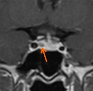 Pituitary microadenoma – Radiology Cases