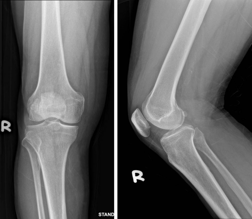 Bipartite patella – Radiology Cases