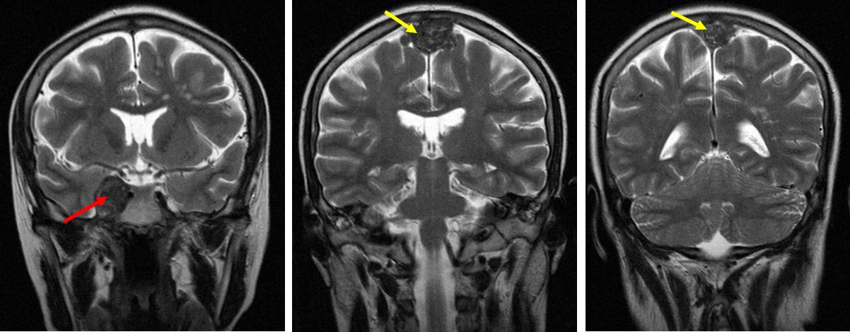 Inflammatory pseudotumour: Lung, liver, spleen and brain involvement ...