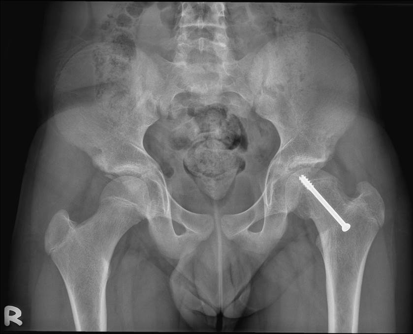 Slipped Upper Femoral Epiphysis Radiology Cases