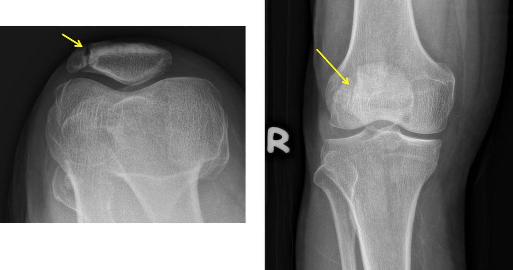 Bipartite patella – Radiology Cases