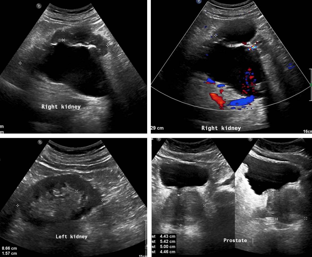 Bilateral ureteric calculi – Radiology Cases