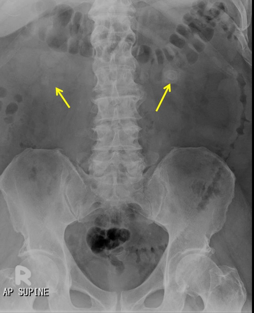 Renal Abscesses Radiology Cases