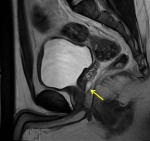 Prostatic utricle cyst – Radiology Cases