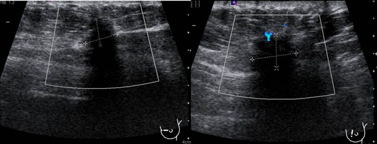 Ductal carcinoma in situ – Radiology Cases