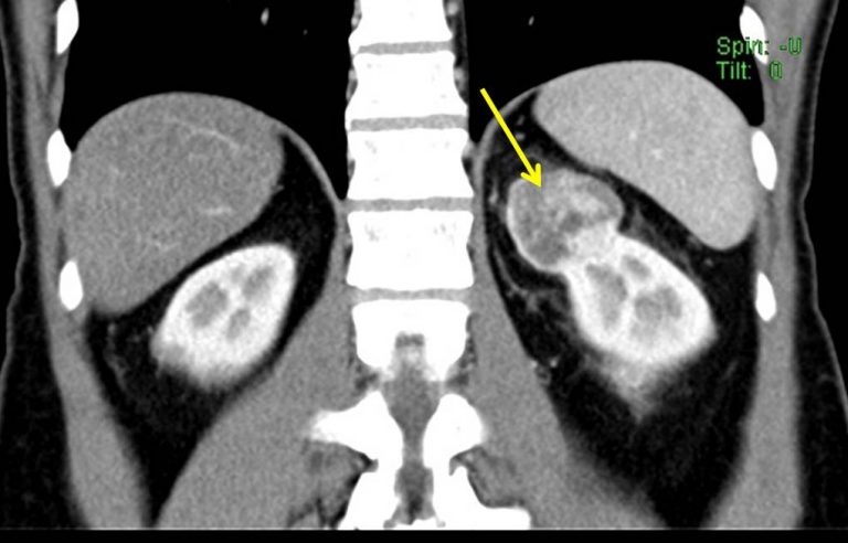 Renal oncocytoma – Radiology Cases