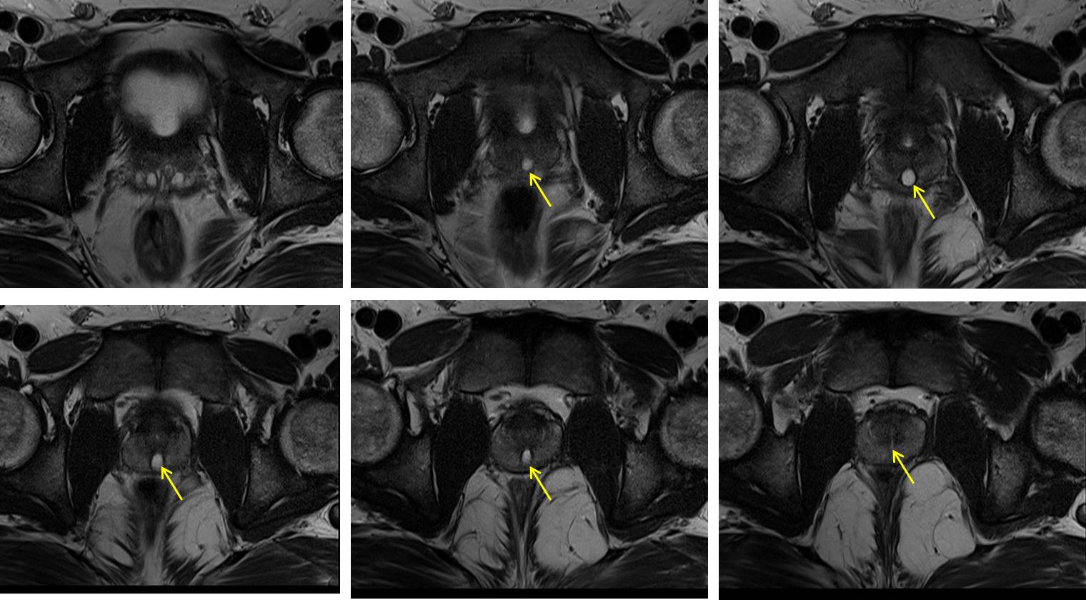 Prostatic utricle cyst – Radiology Cases