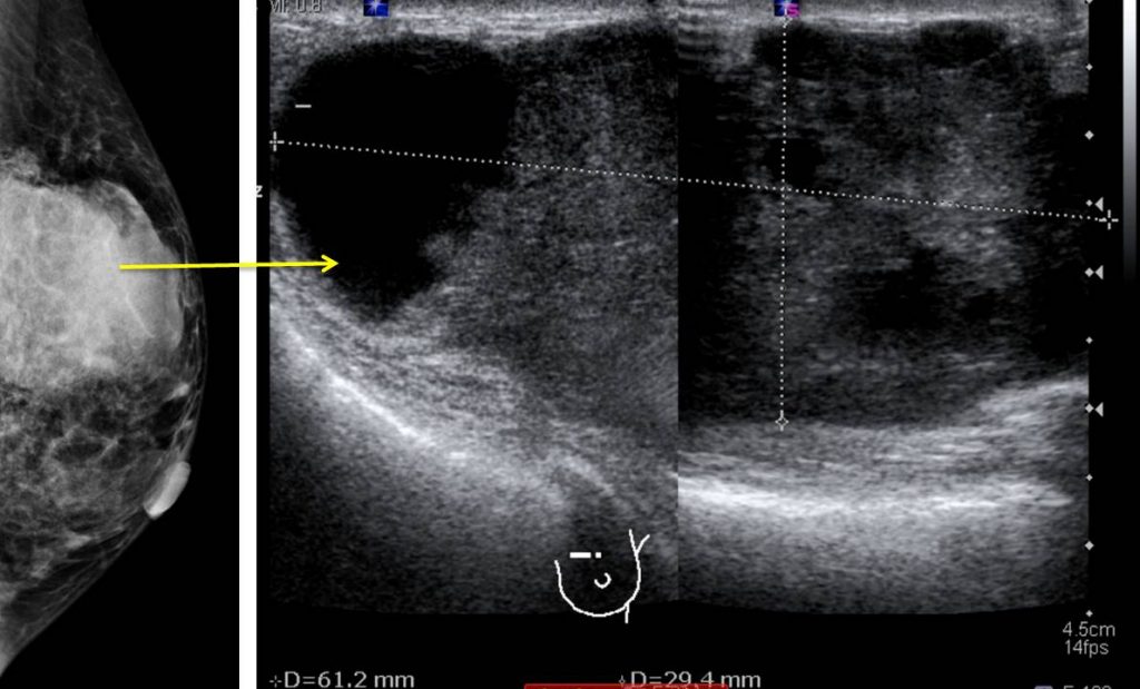 invasive-breast-carcinoma-of-no-special-type-radiology-cases