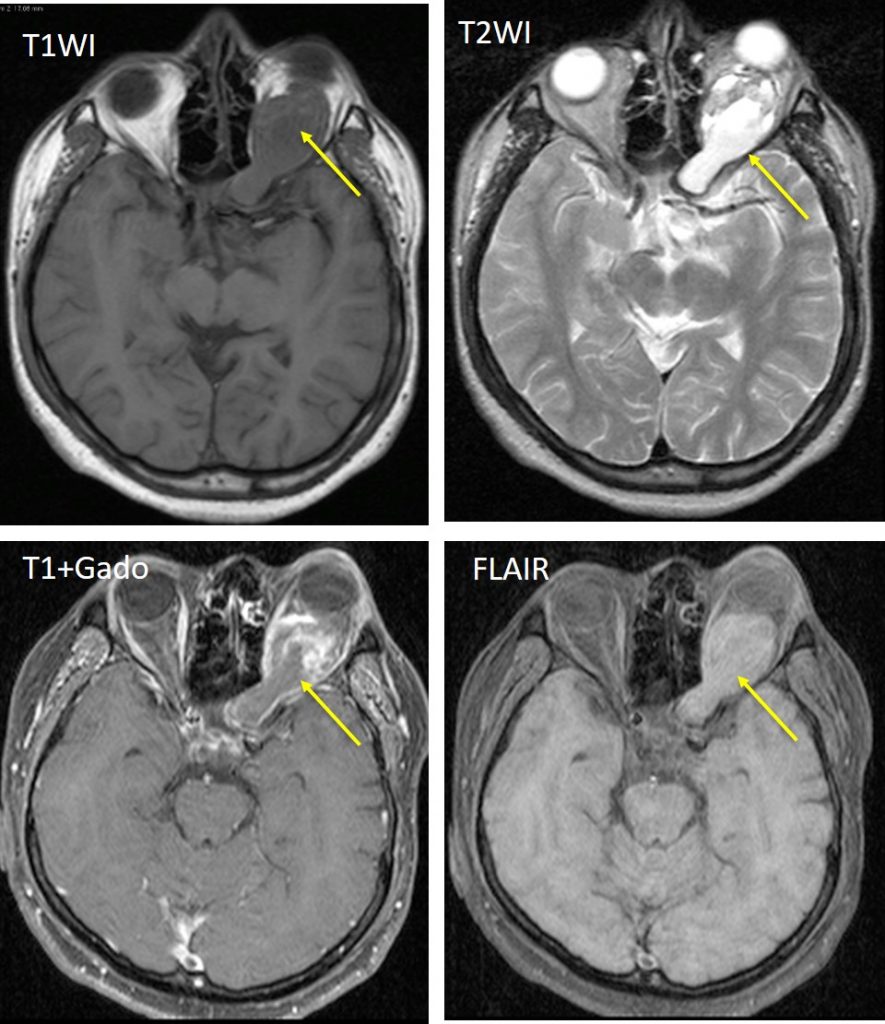 Optic Nerve Glioma Radiology Cases