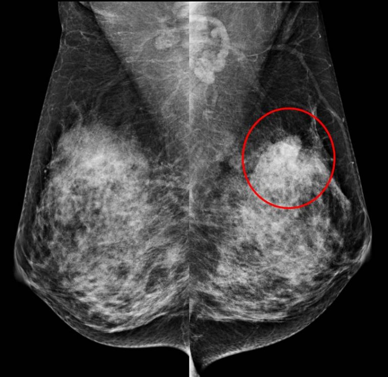 Mammogram Focal Asymmetry Radiology Cases 7109
