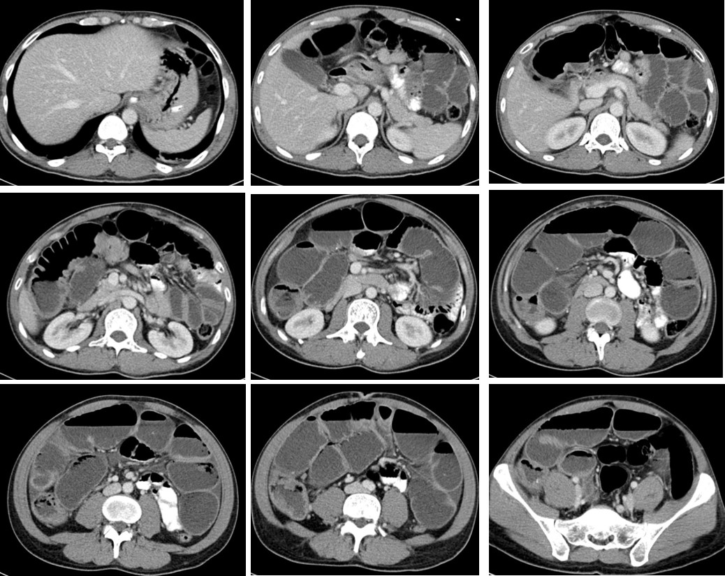 bowel-obtruction-by-tumour-radiology-cases