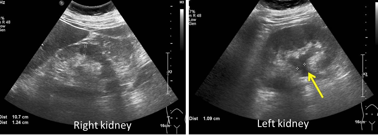 Septic shock due to pyonephrosis – Radiology Cases