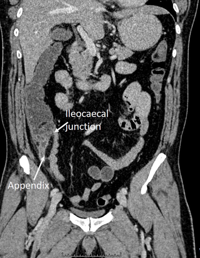 Acute appendicitis: subcaecal appendix – Radiology Cases