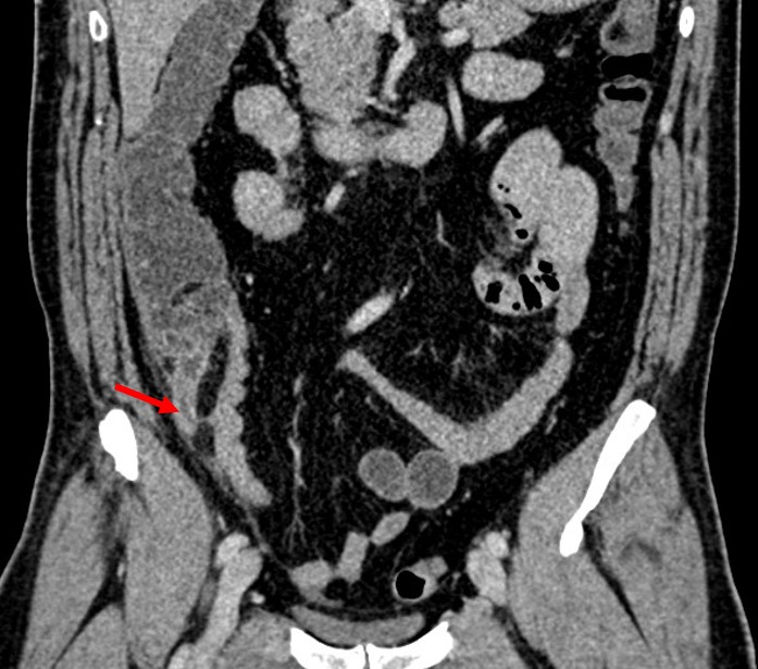 Acute Appendicitis Subcaecal Appendix Radiology Cases