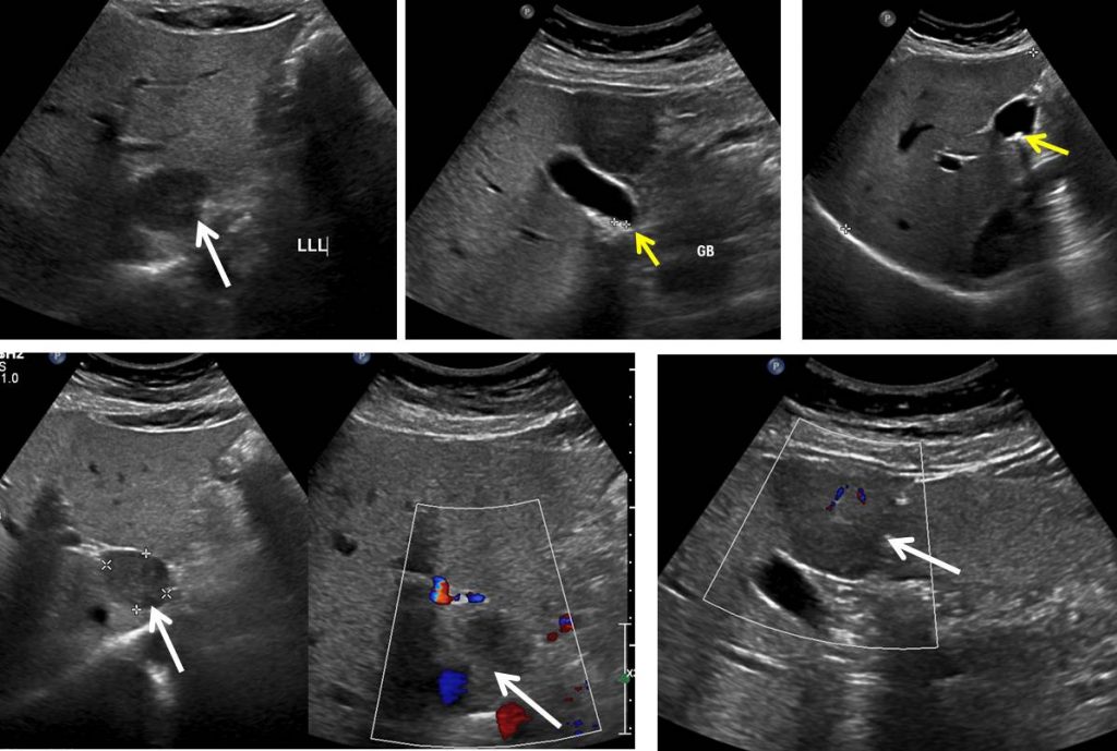 Focal nodular hyperplasia of liver – Radiology Cases