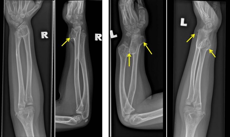 Multiple Exostoses Hereditary multiple exostosis – Radiology Cases