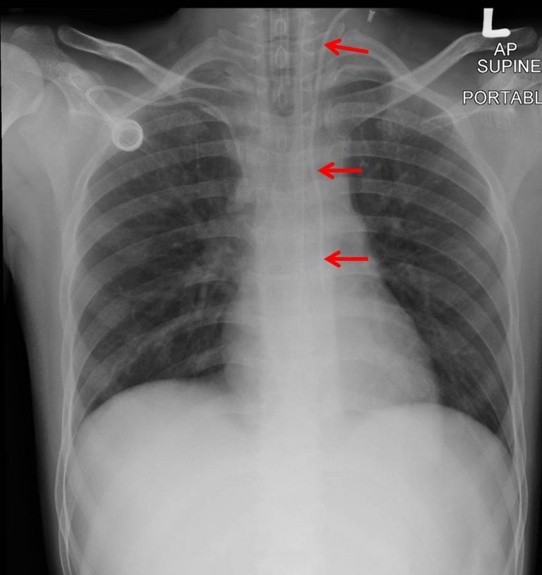 Inadvertent carotid artery cannulation – Radiology Cases