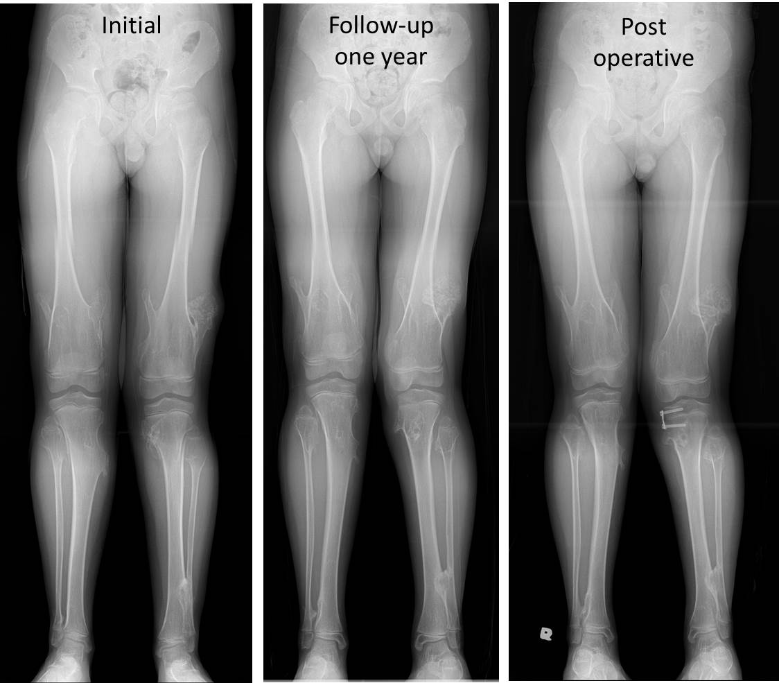 Multiple Exostoses Hereditary multiple exostosis – Radiology Cases