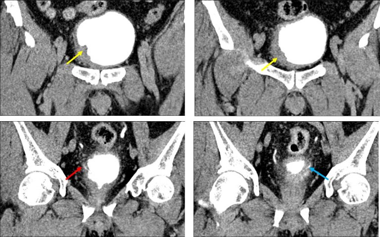 Urothelial carcinoma of the bladder – Radiology Cases