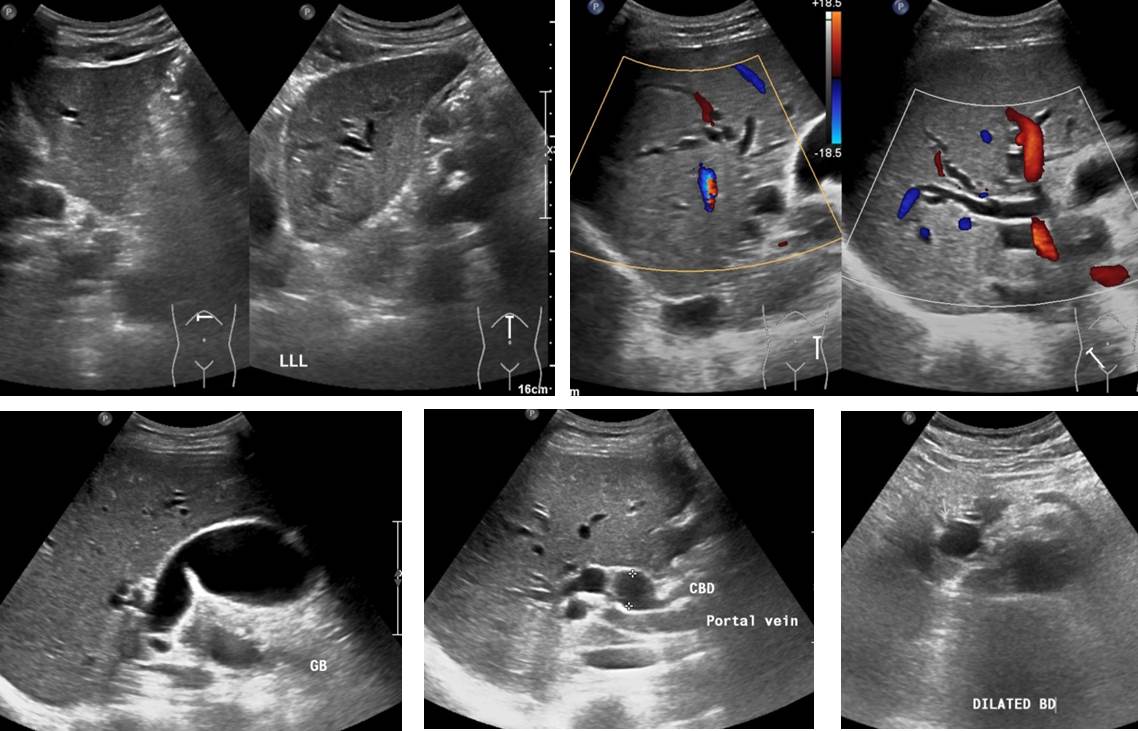 Pancreatic adenocarcinoma – Radiology Cases