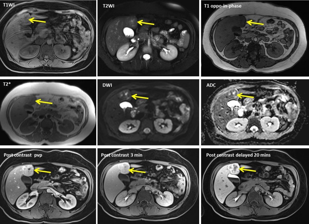 Focal Nodular Hyperplasia Of Liver Radiology Cases