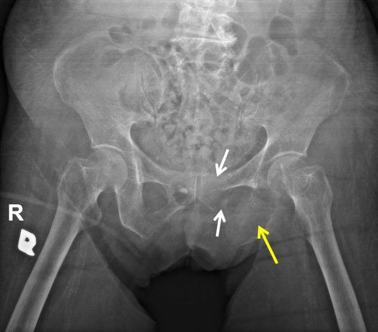 Anaplastic thyroid carcinoma – Radiology Cases