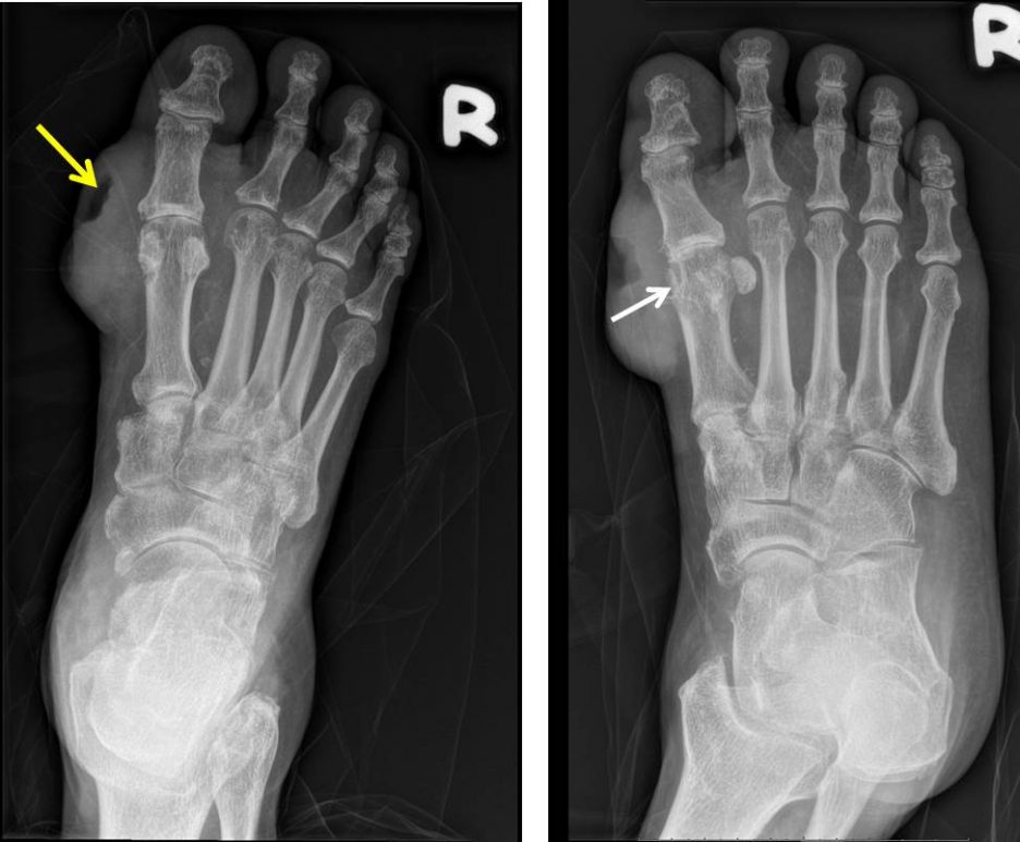 Infection of tophaceous nodule – Radiology Cases