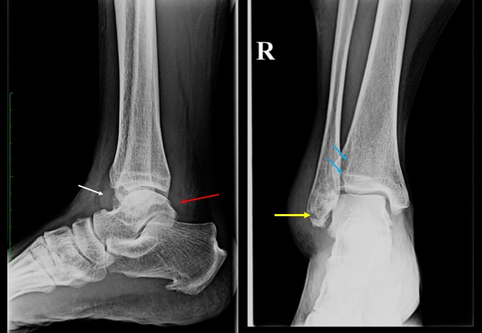 Weber A Fibula Fracture Radiology Cases