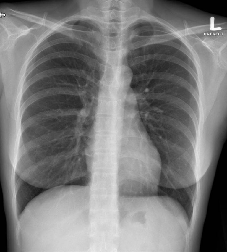 Tuberculous spondylitis – Radiology Cases