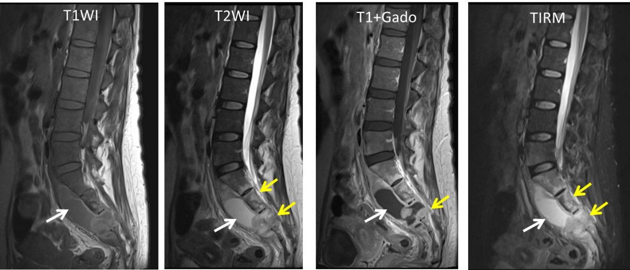 Tuberculous spondylitis – Radiology Cases